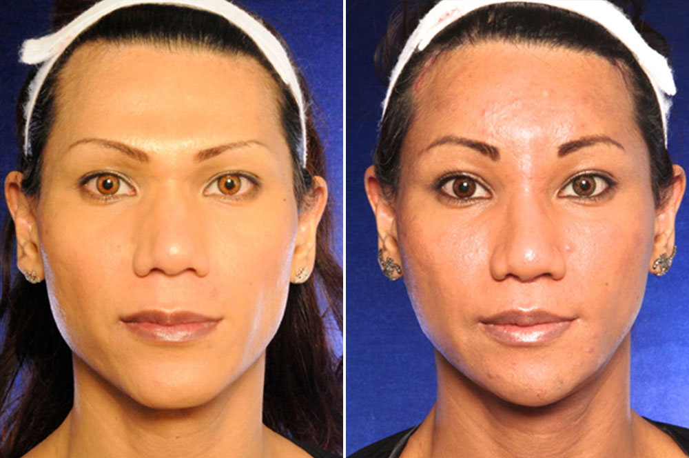 Chin surgery, Forehead recontouring, Jaw angle reduction, Lip lift, Lipofil...