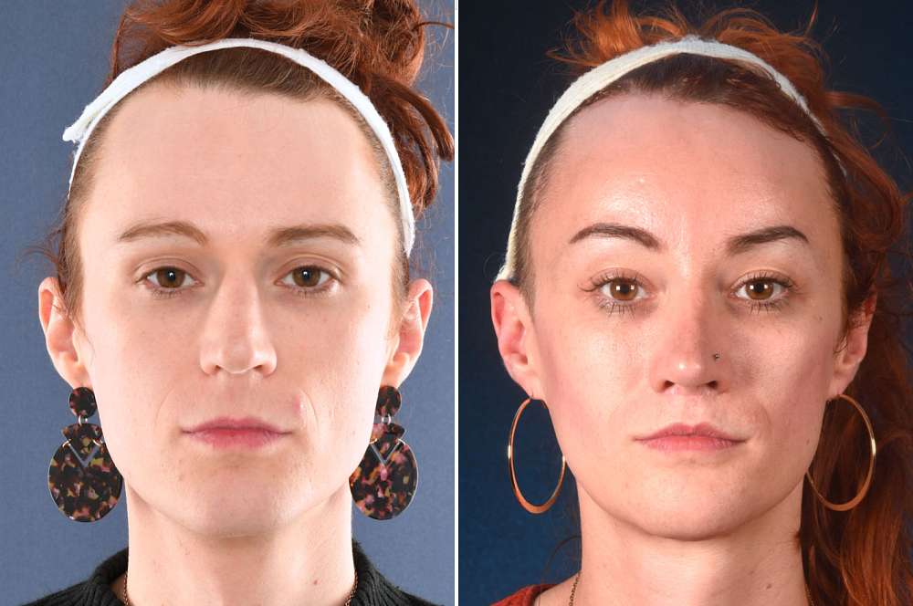 Olive vor und nach der Feminisierung des Gesichts