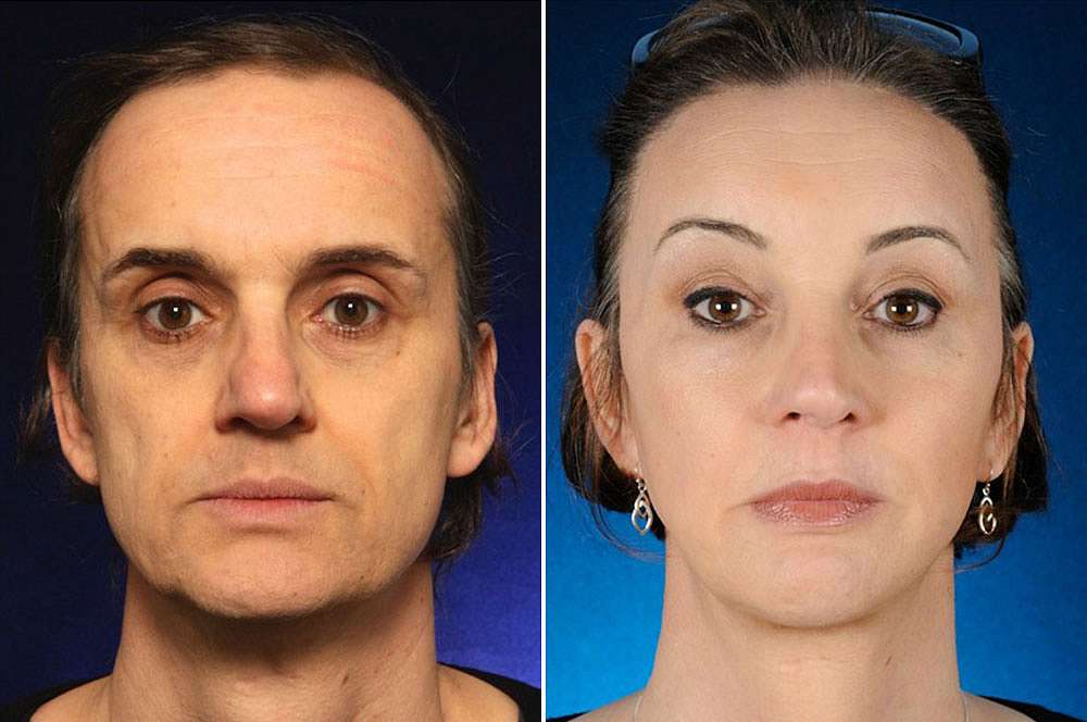 Chris voor en na Facial Feminization Surgery