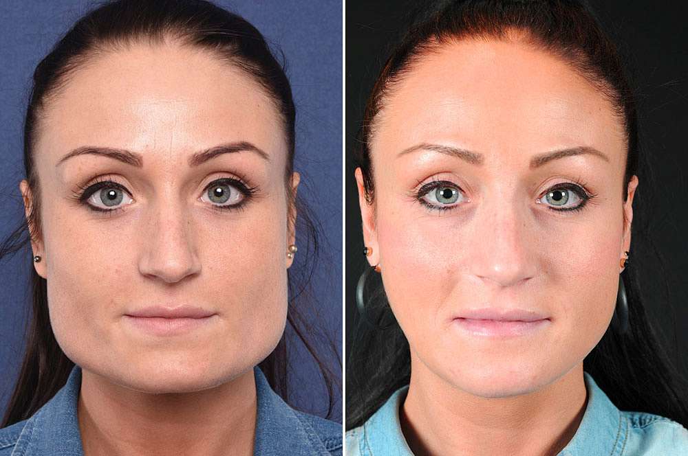 Charlotte voor en na Facial Feminization Surgery