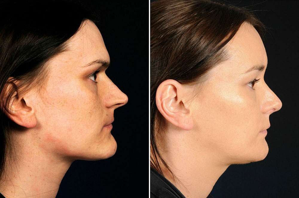 Layla voor en na Facial Feminization Surgery