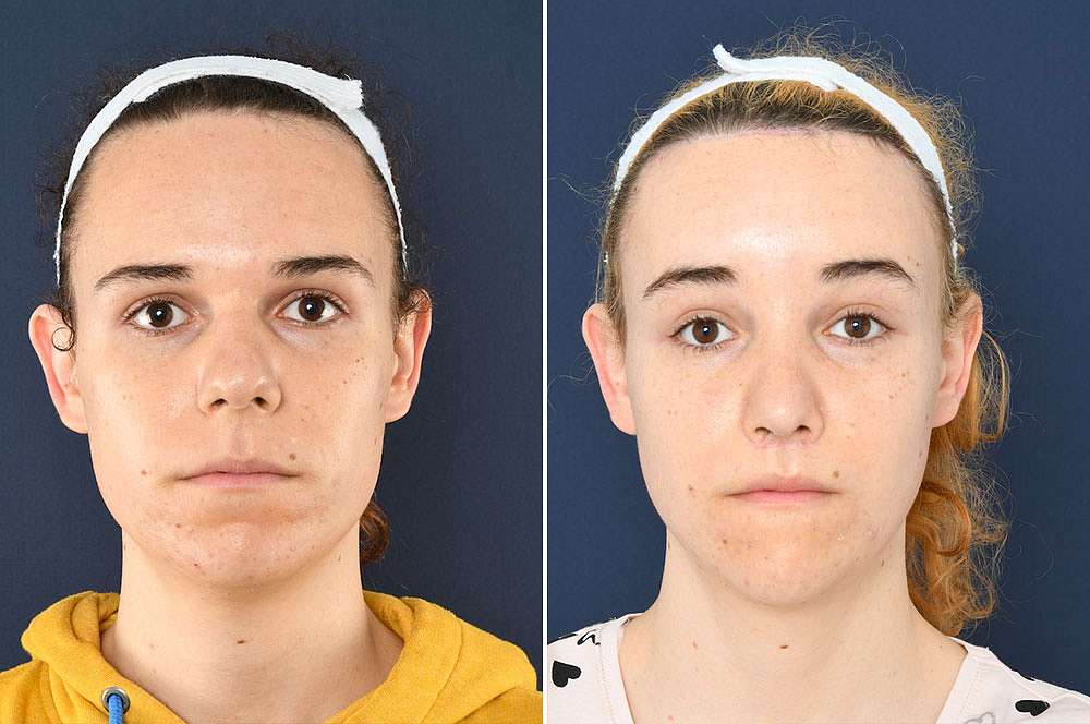 Felina voor en na Facial Feminization Surgery