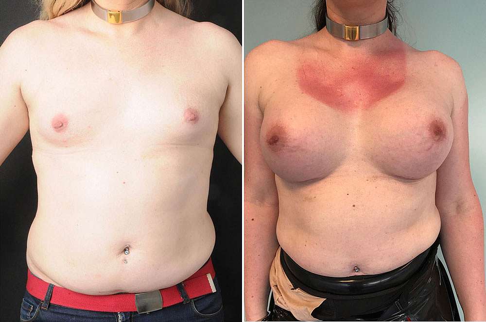 Breast implants - Mtf vor und nach der Feminisierung des Körpers