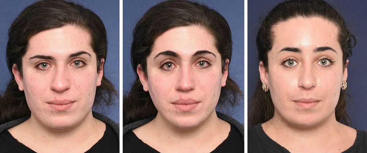 Sense and non-sense of simulations before your facial feminization surgery