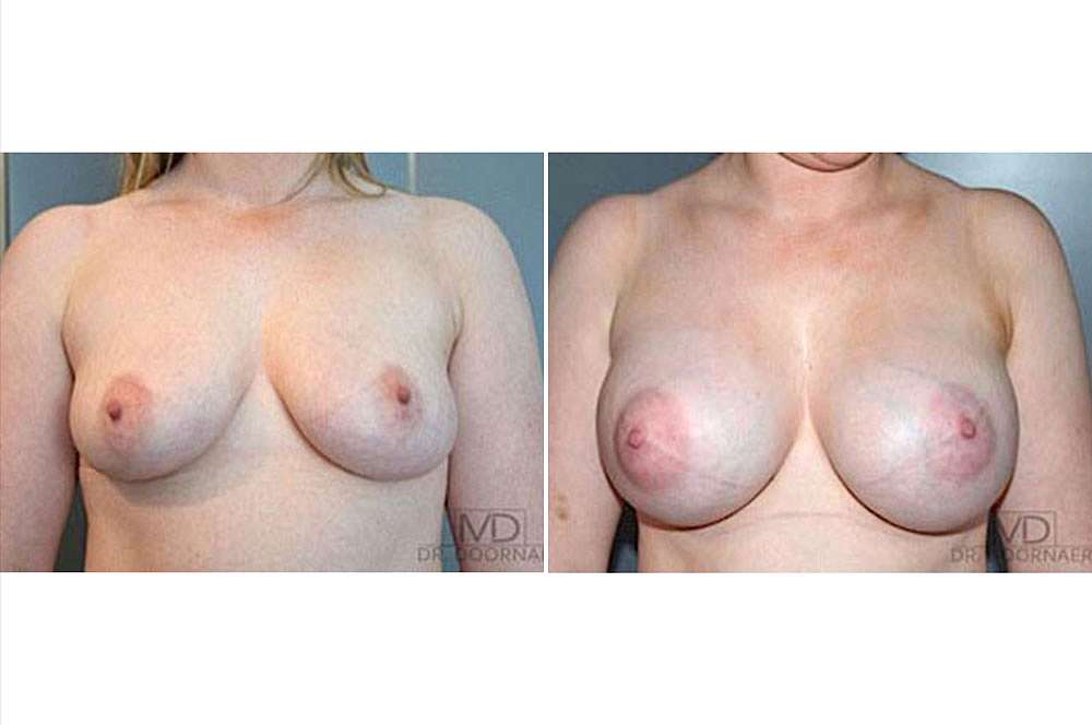 Breast implants - Mtf voor en na Body Feminization Surgery