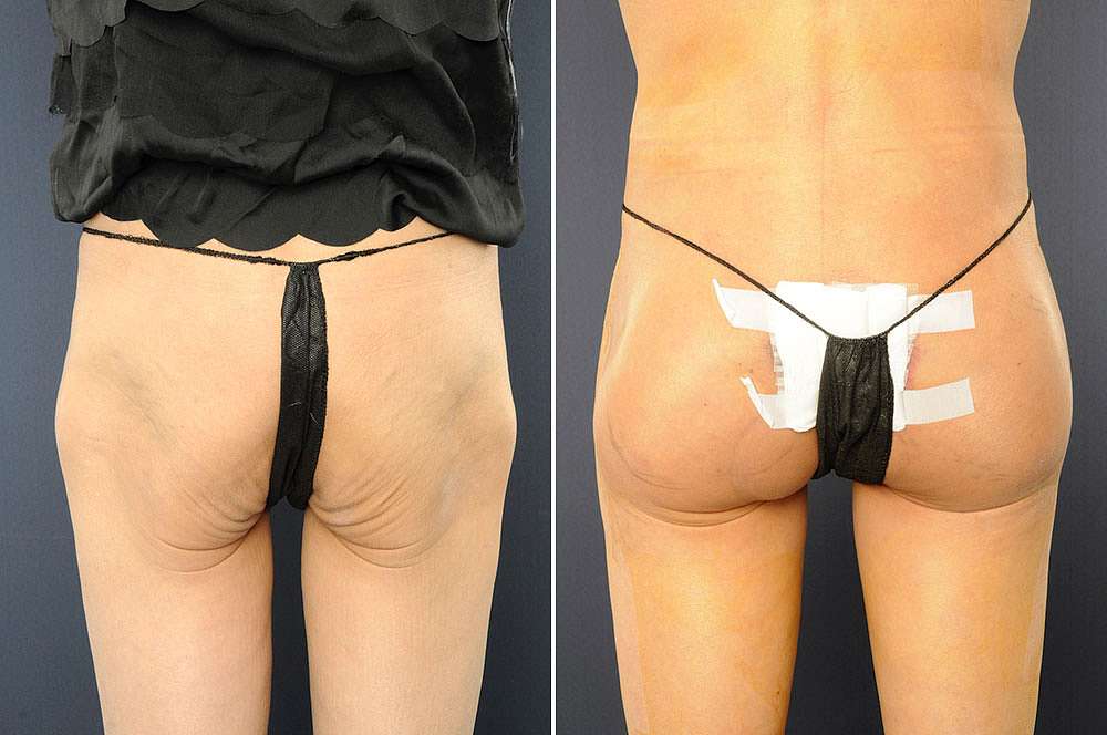 Butt implants vor und nach der Feminisierung des Körpers