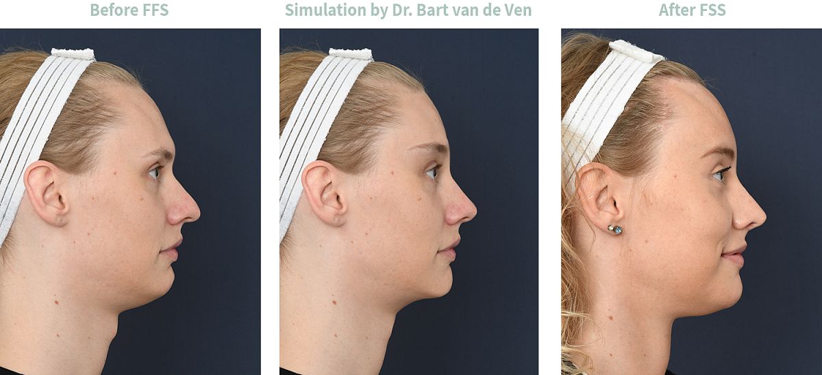 Foto simulatie Facial Feminization Surgery Nicky de Jong