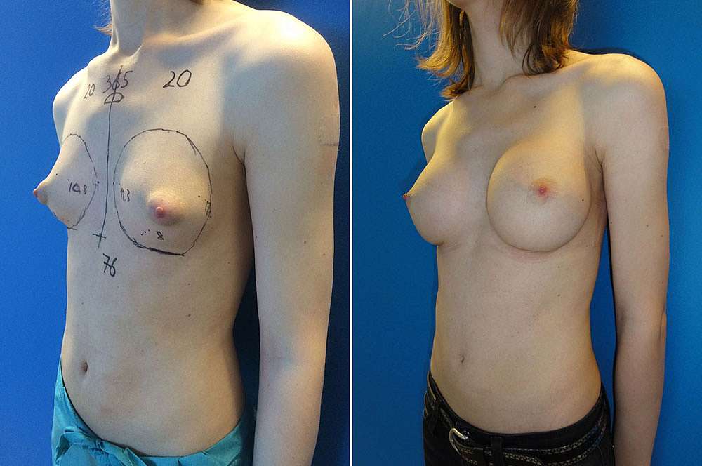 Breast implants - Mtf before and after Body Feminization Surgery 