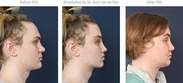 Evelyn Before And After FFS - 2pass Clinic