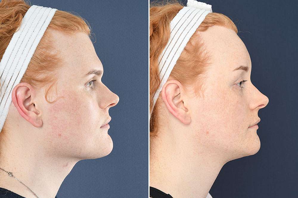 Gwen voor en na Facial Feminization Surgery