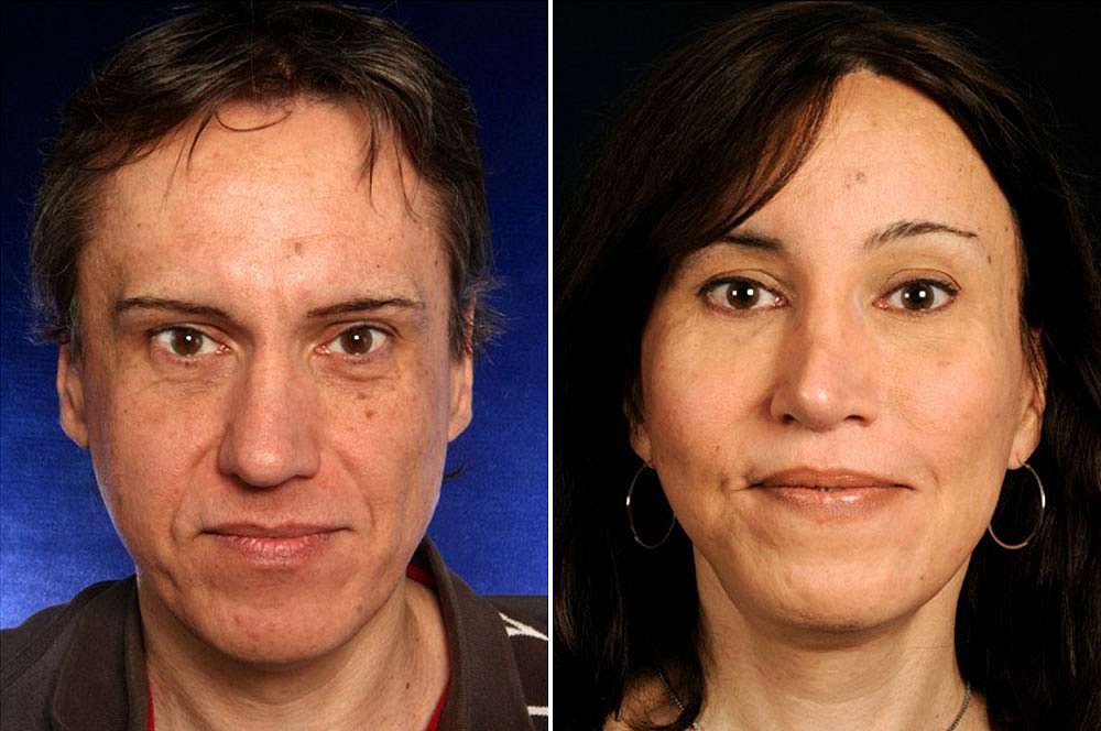 Dora voor en na Facial Feminization Surgery