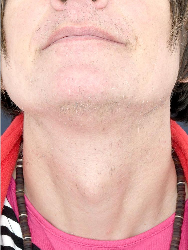 Result after 60 hours electrolysis after treatment