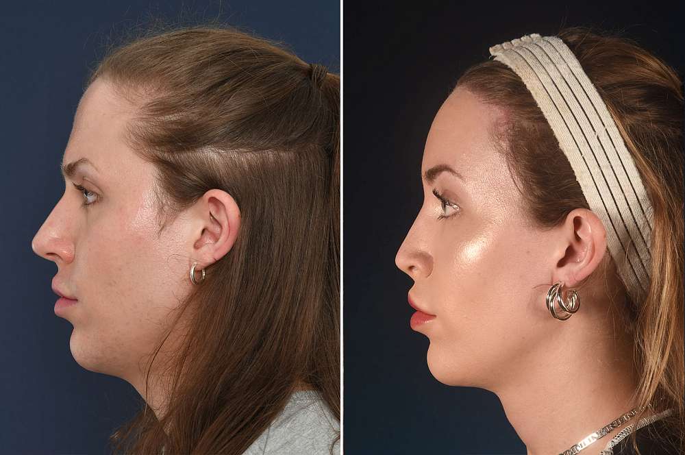 Eden voor en na Facial Feminization Surgery