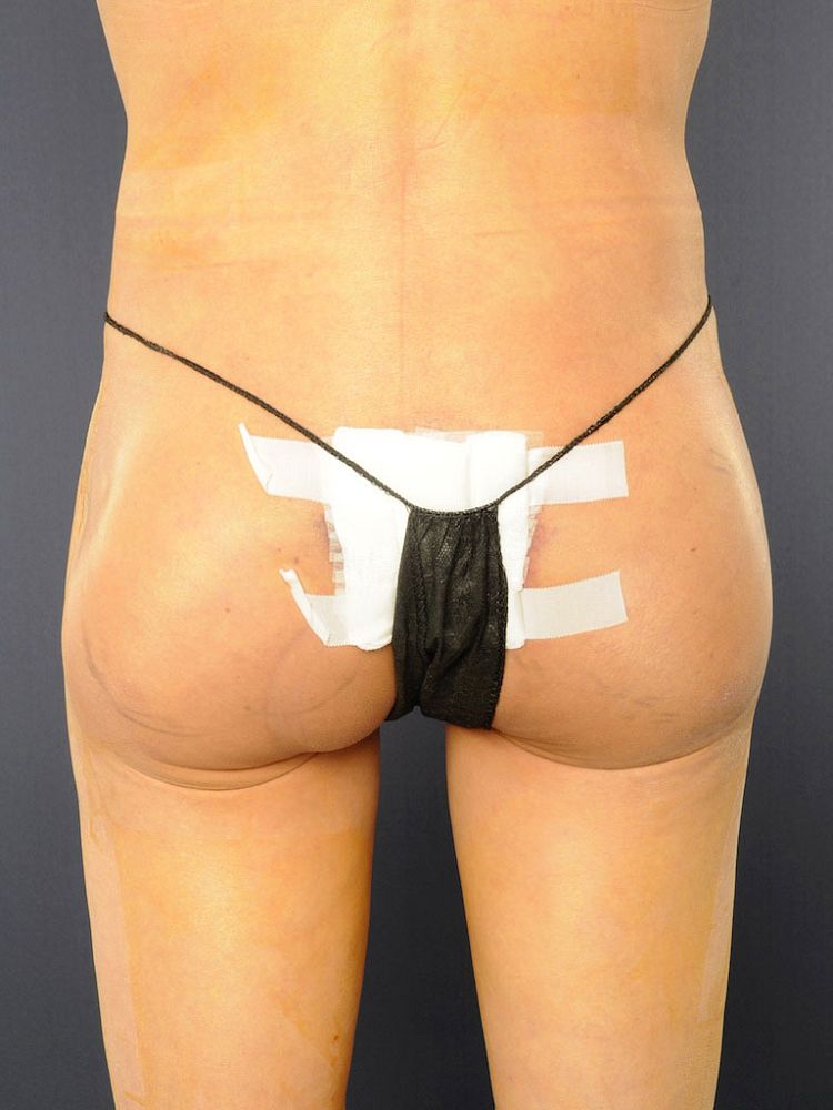 Butt implants nachher BFS