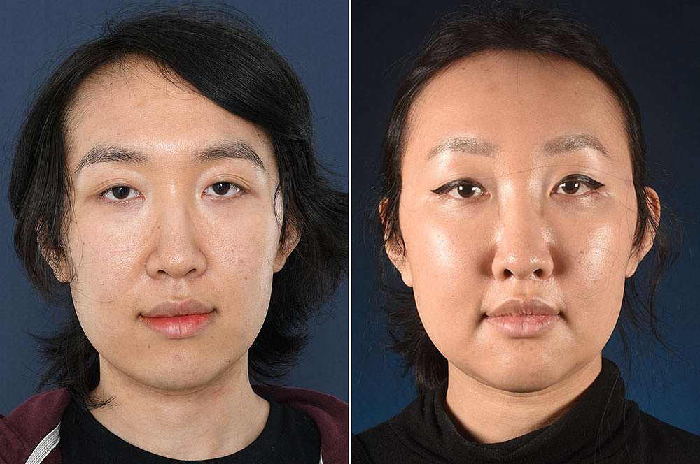 Louise voor en na Facial Feminization Surgery