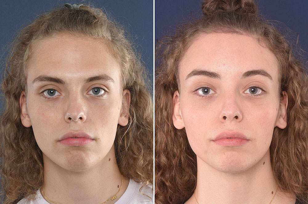Len voor en na Facial Feminization Surgery