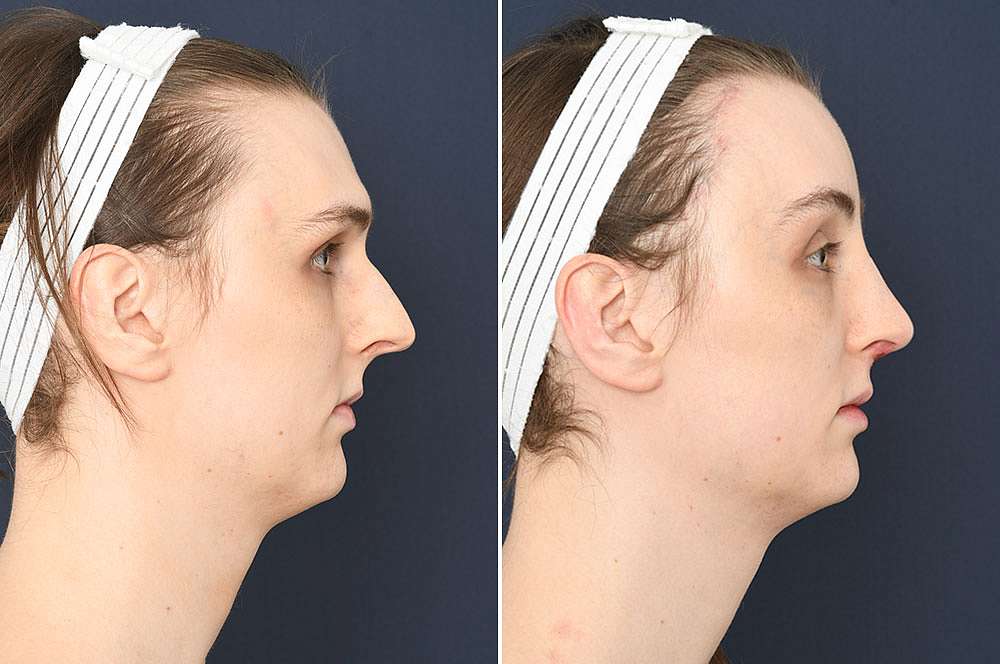 Jolien before and after Facial Feminization Surgery