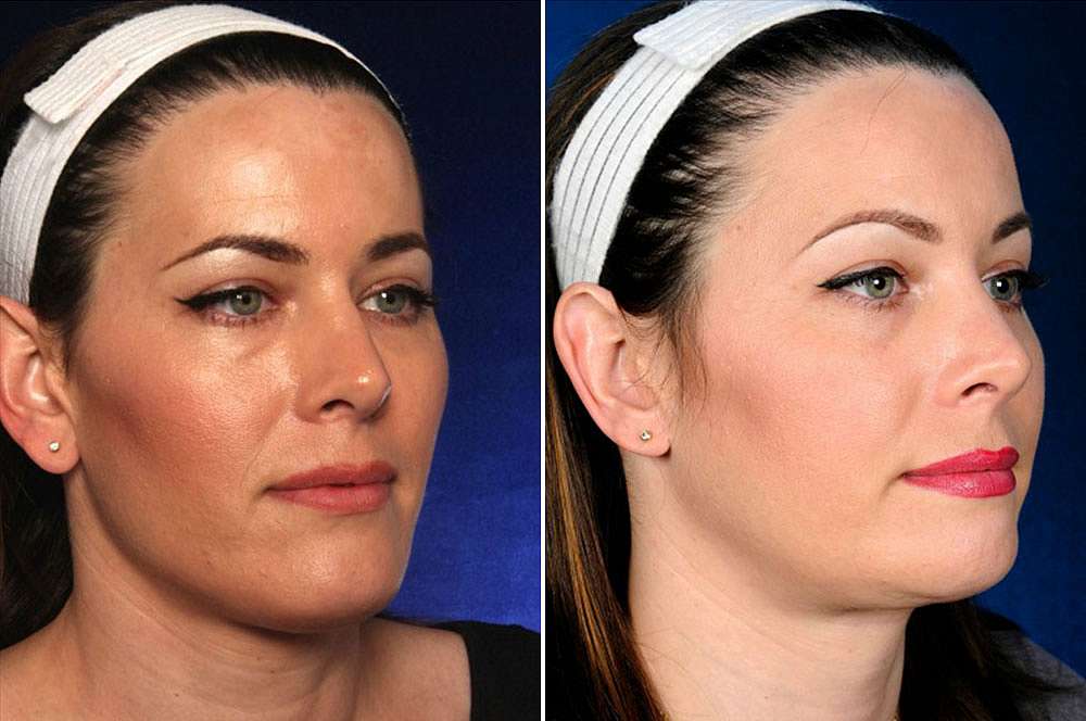Joyce voor en na Facial Feminization Surgery