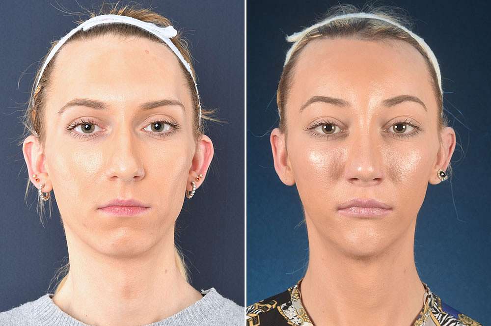 Paris vorher und nachher Facial Feminization Surgery