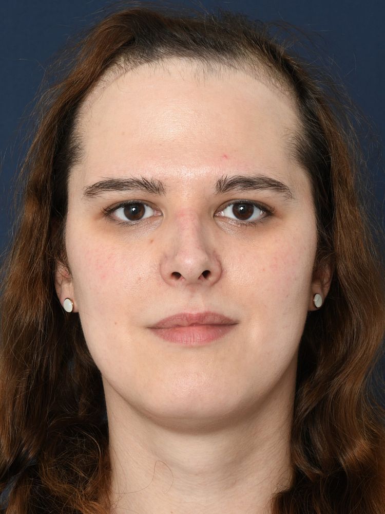 Vorher Facial Feminization Surgery Katharina-Sophia