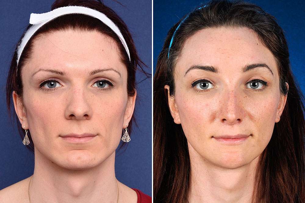 Mia voor en na Facial Feminization Surgery