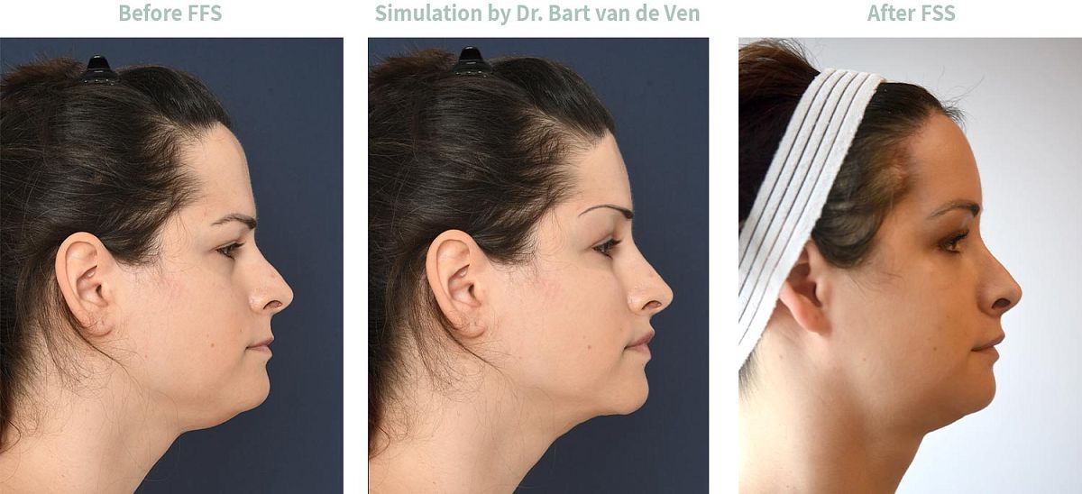 Foto simulatie Facial Feminization Surgery Annalena