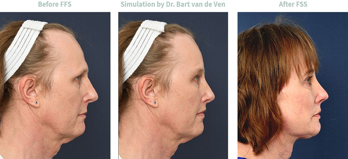 Foto simulatie Facial Feminization Surgery Rachael