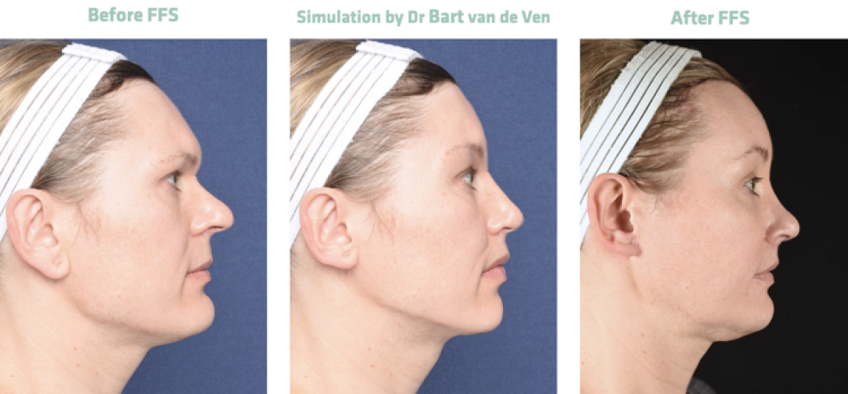 Foto simulatie Facial Feminization Surgery Mila