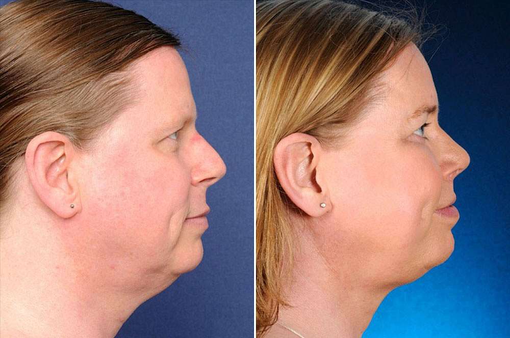 Beatrice voor en na Facial Feminization Surgery