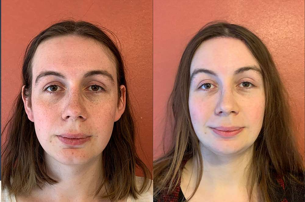 Lily voor en na Facial Feminization Surgery