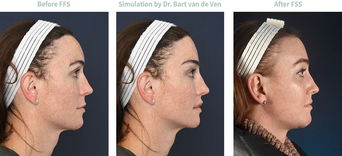 Foto simulatie Facial Feminization Surgery Jamie