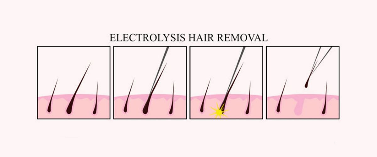 Is electrolysis hair removal painful 2pass Clinic