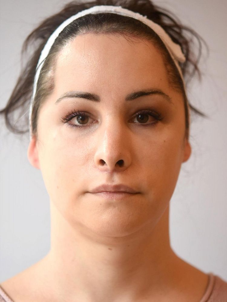 Na Facial Feminization Surgery Annalena