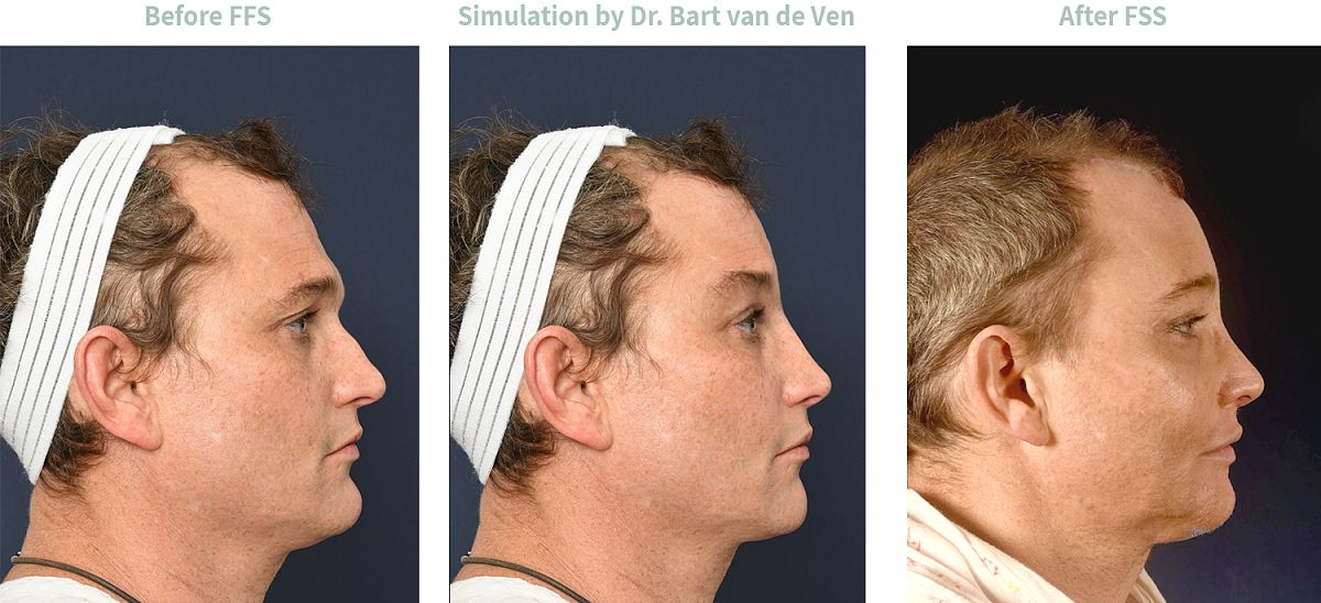 Picture simulation Facial Feminization Surgery Jana Marie