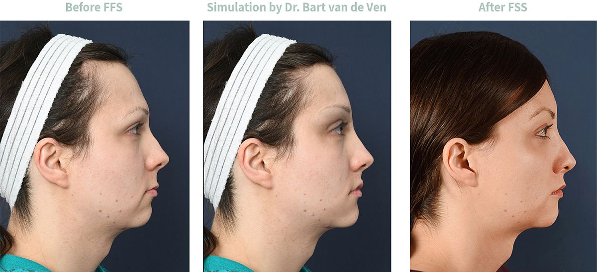 Bildsimulation Facial Feminization Surgery Selene