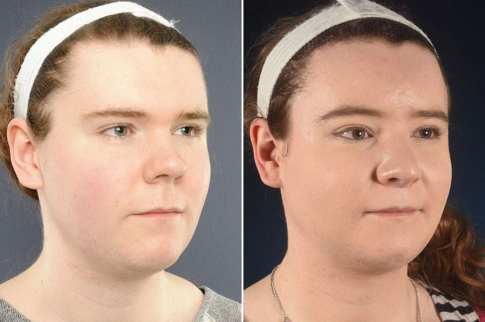 Emily voor en na Facial Feminization Surgery
