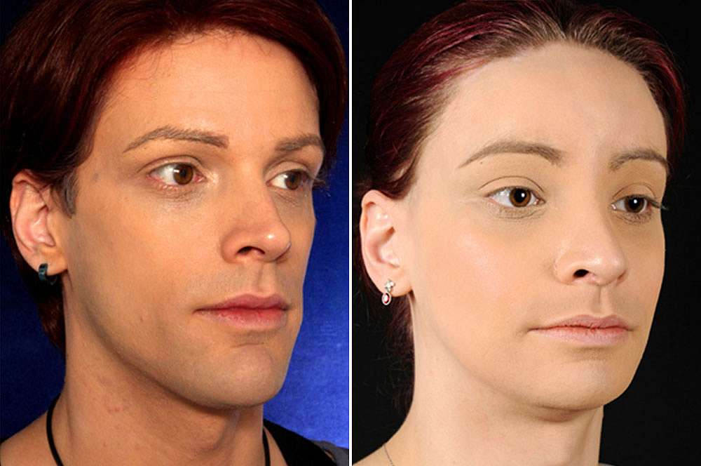 Elise voor en na Facial Feminization Surgery