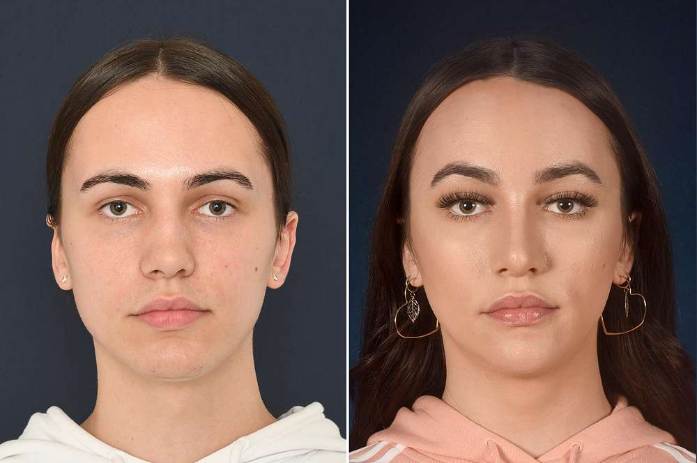 Maddy vor und nach der Feminisierung des Gesichts