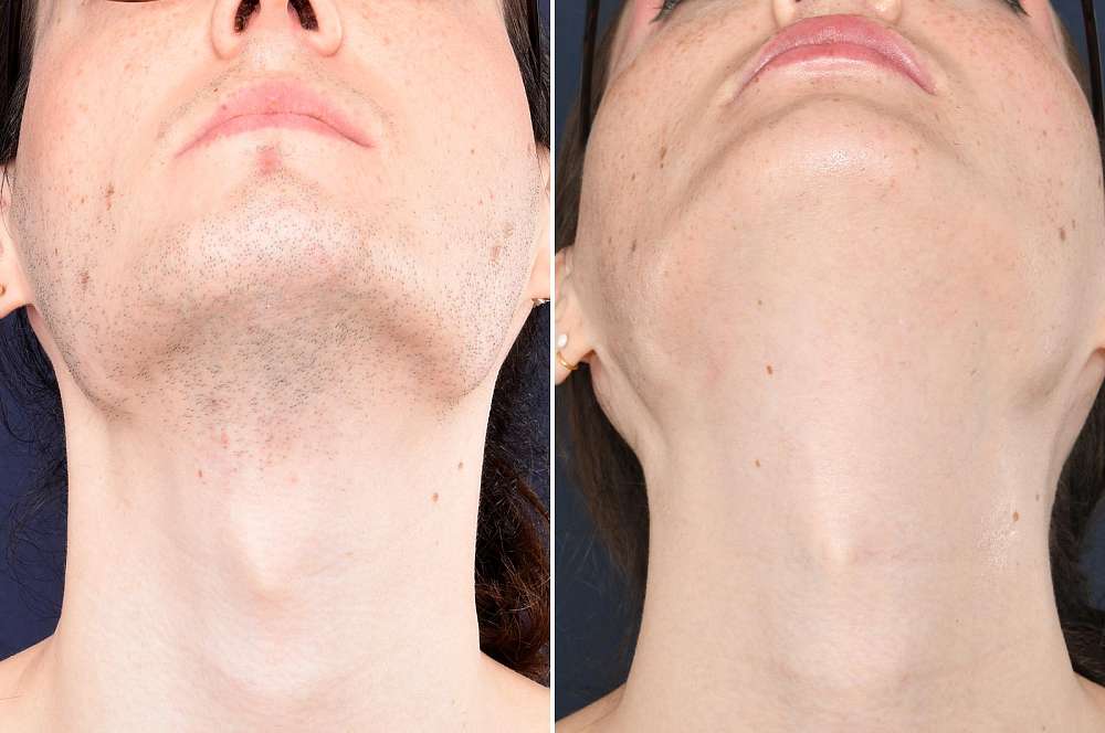 Result after 9 sessions laser treatment and 4 hours electrolysis before and after 