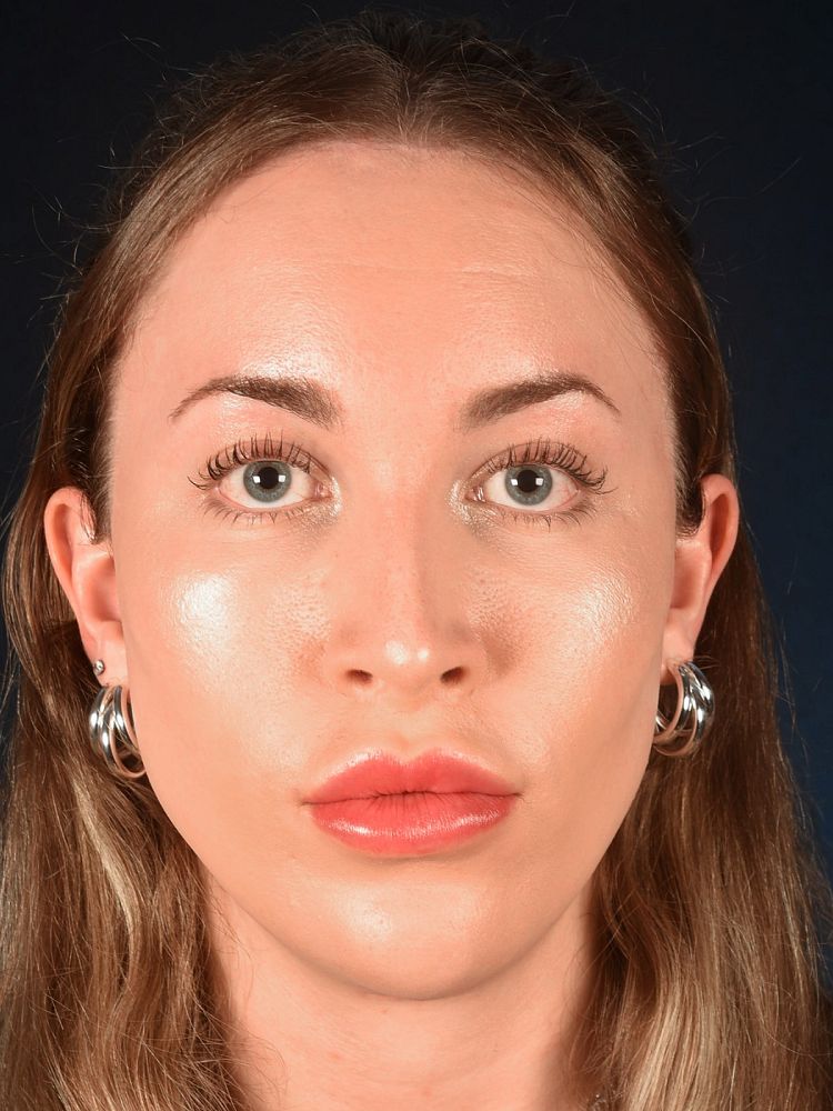 Na Facial Feminization Surgery Eden