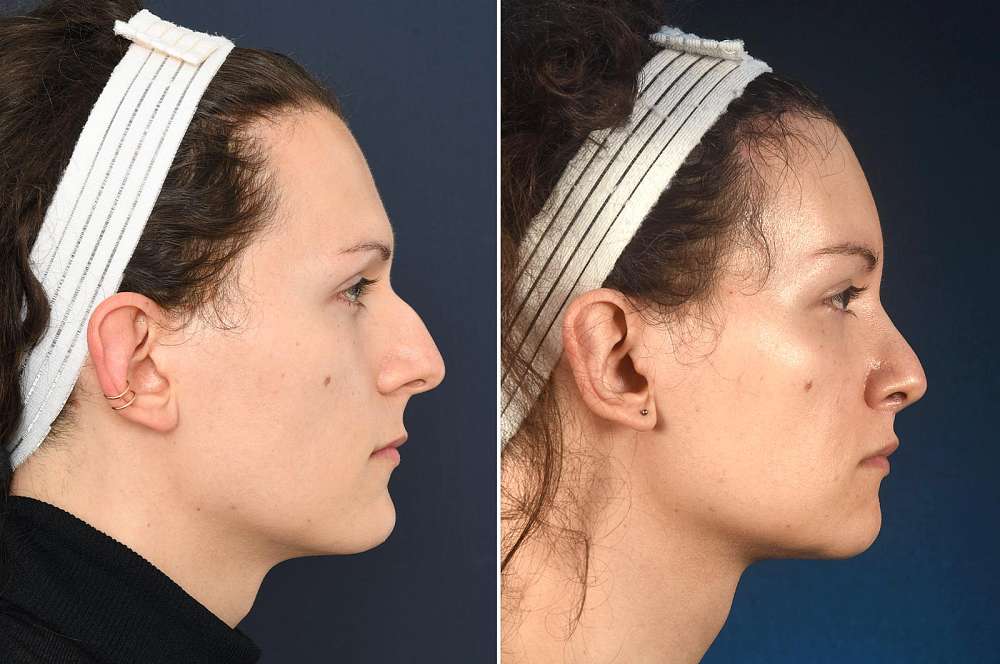 Alex voor en na Facial Feminization Surgery