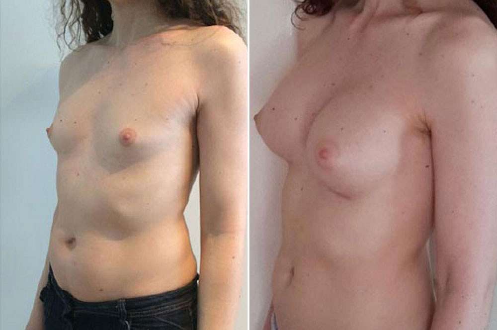 Breast implants - Mtf before and after Body Feminization Surgery