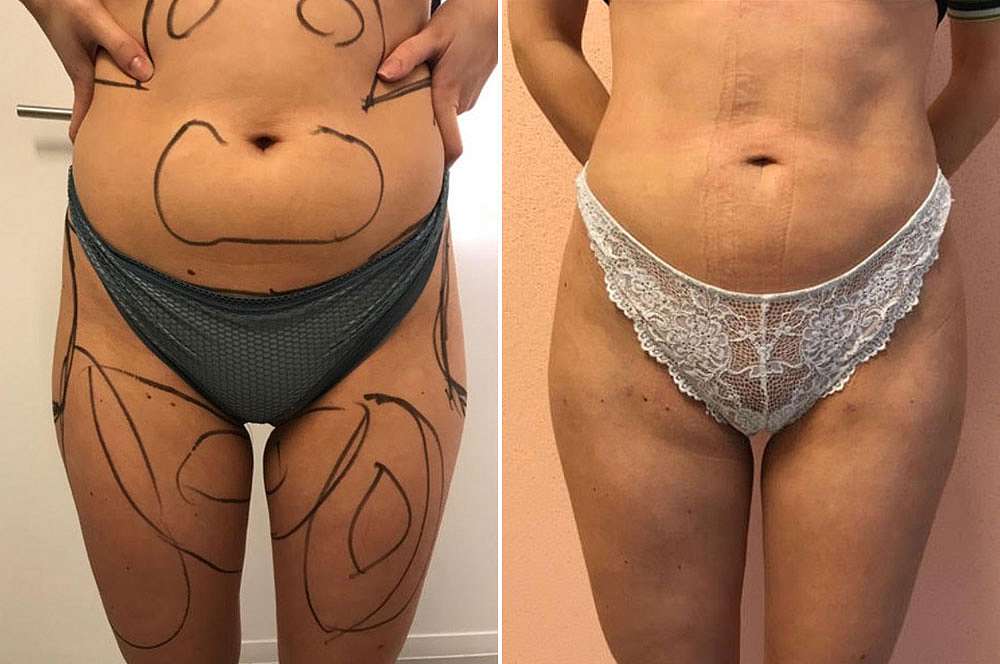 Hip augmentation by fat transfer voor en na Body Feminization Surgery