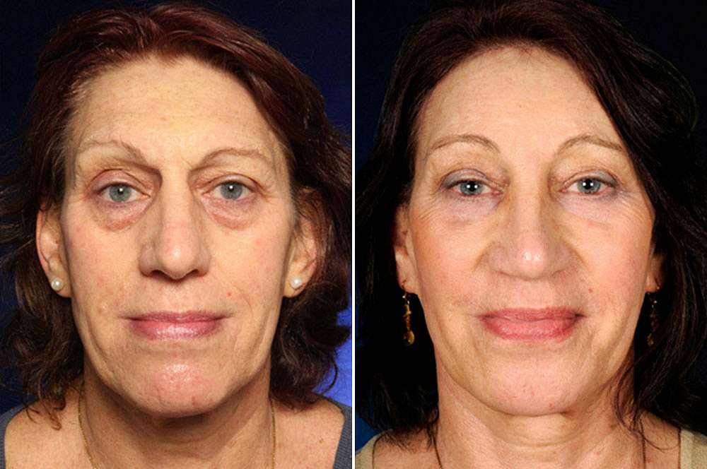 Rachel voor en na Facial Feminization Surgery