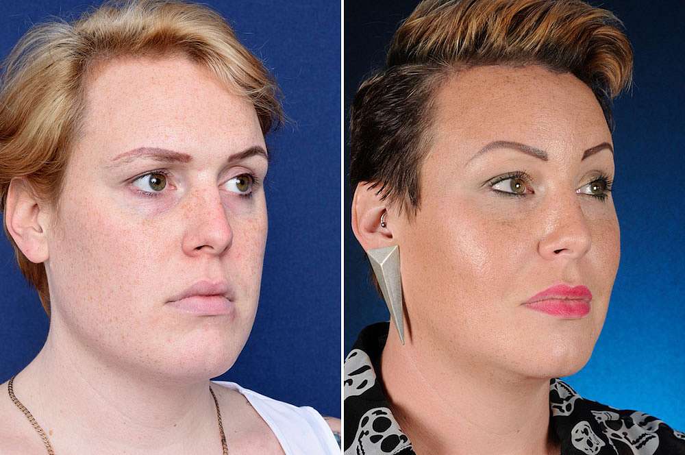 Alexia voor en na Facial Feminization Surgery