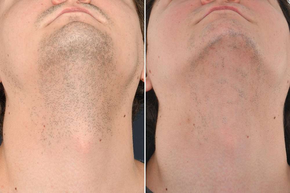 Result after 4 sessions laser treatment before and after 
