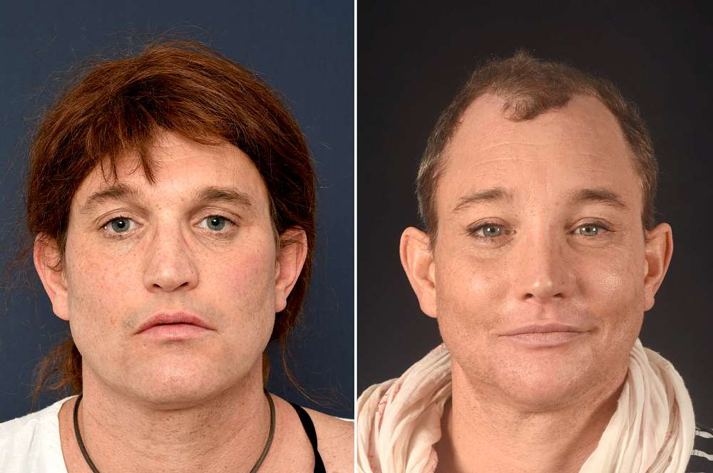 Jana Marie voor en na Facial Feminization Surgery