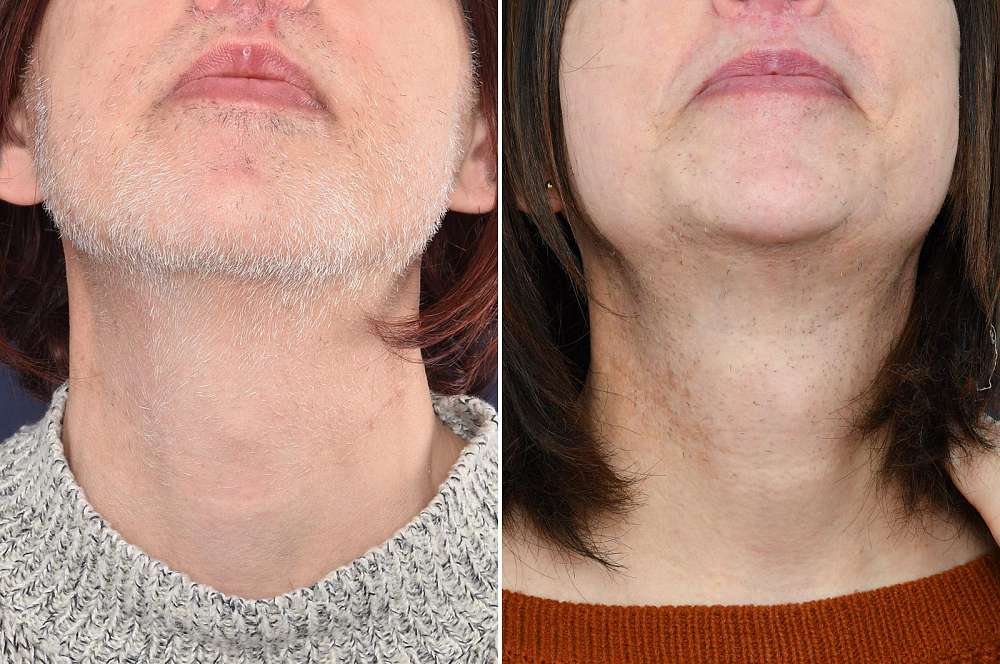 Result after 38 hours of electrolysis before and after 