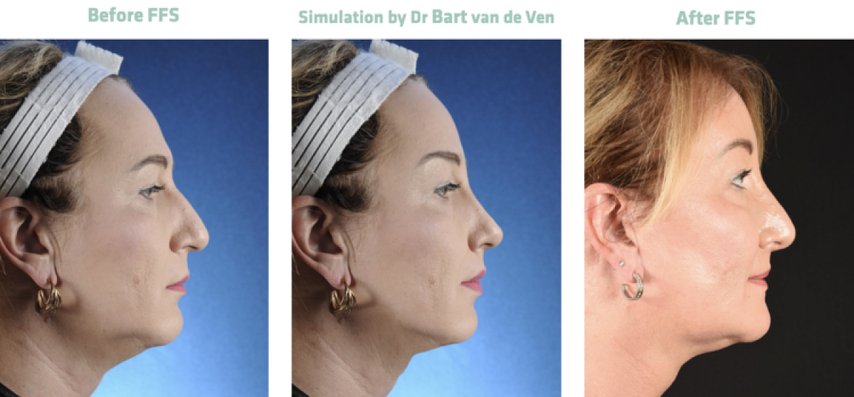 Foto simulatie Facial Feminization Surgery Olivia