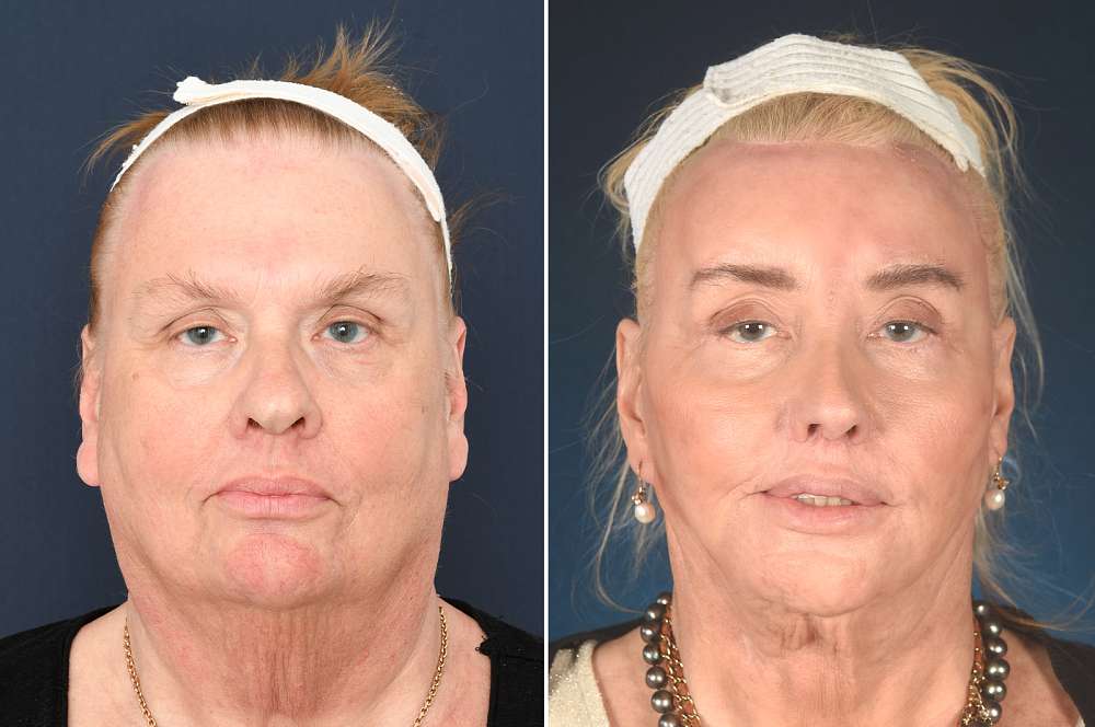 Louise voor en na Facial Feminization Surgery